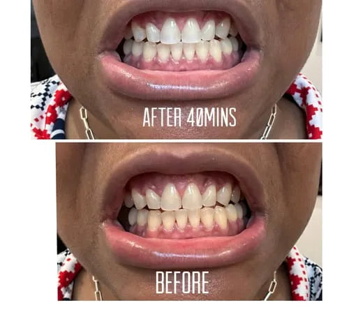 Whitening Strips (16-Day Treatment)