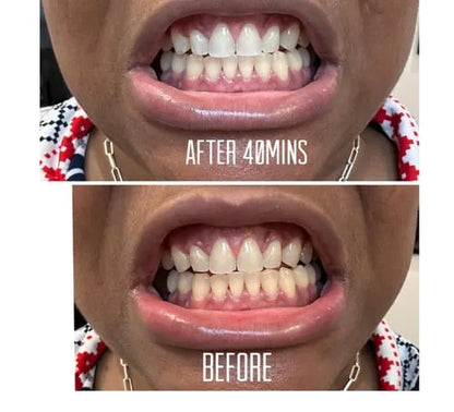 Whitening Strips (16-Day Treatment)